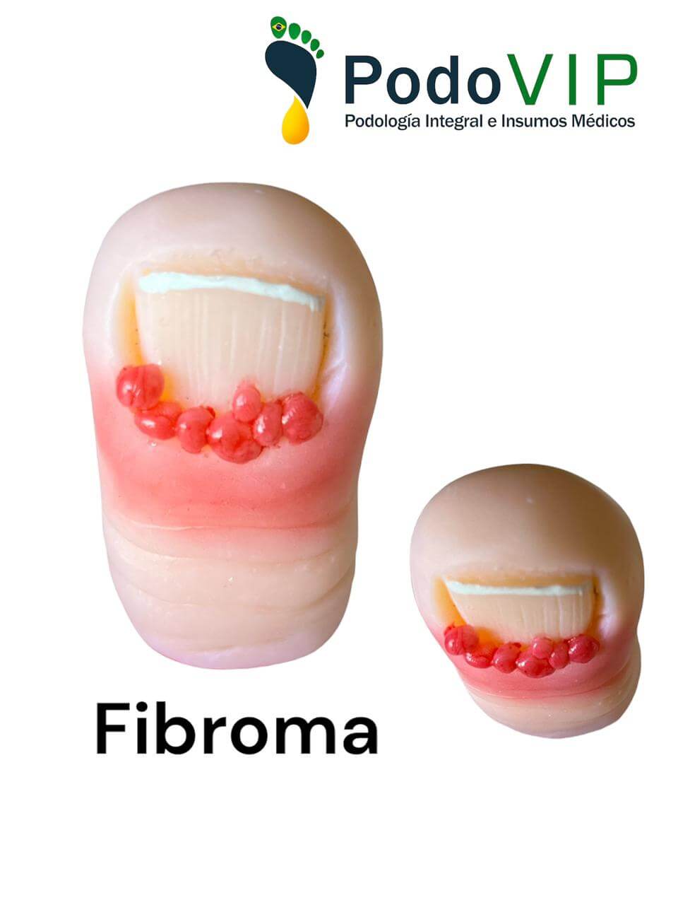 Fibroma