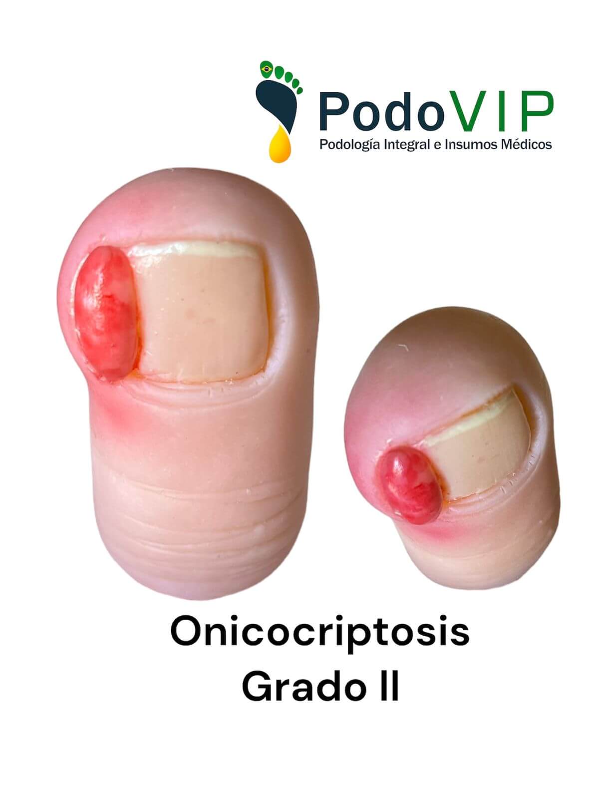 Onicocriptosis Grado 2