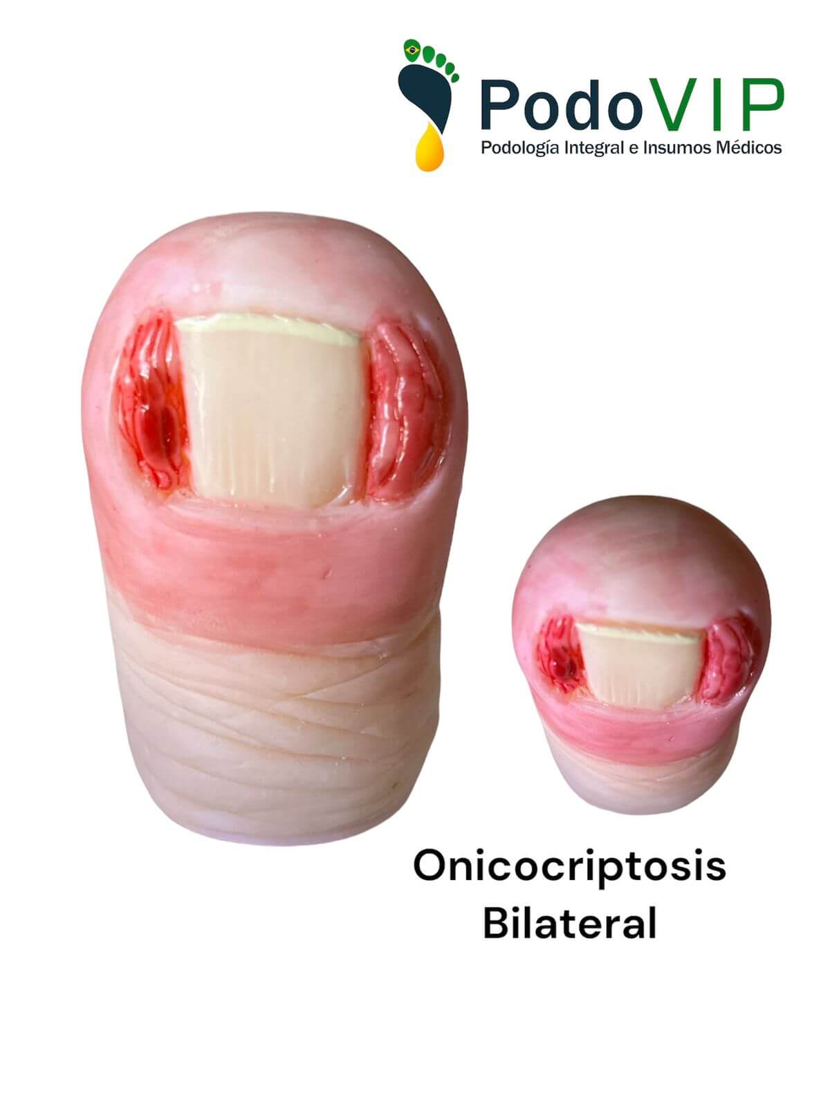 Onicocriptosis Bilateral