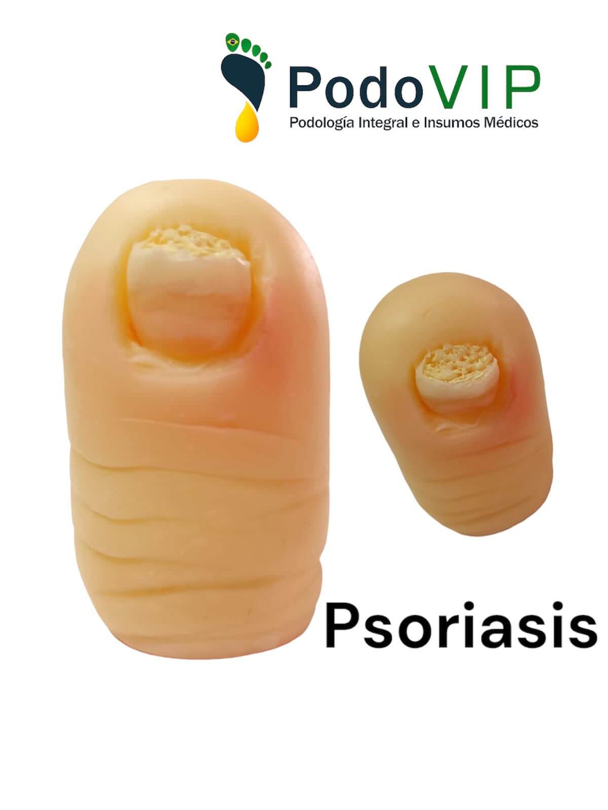 Psoriasis